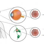 Representación gráfica del tumor en una imagen del dibujo de un ojo en su estructura interna.
https://www.agenciacyta.org.ar/content/uploads/2020/10/IMAGEN-2-Infografia-150x150.jpg